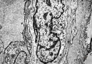 F,6m. | capillary hemangioma - hard palate F,6m. | capillary hemangioma - hard palate